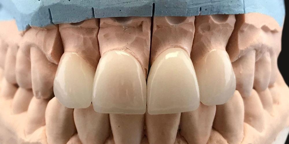 zirconia tooth cap zirconia crown for primary teeth