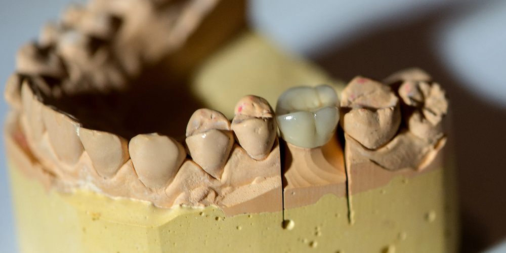 monolithic fixed teeth