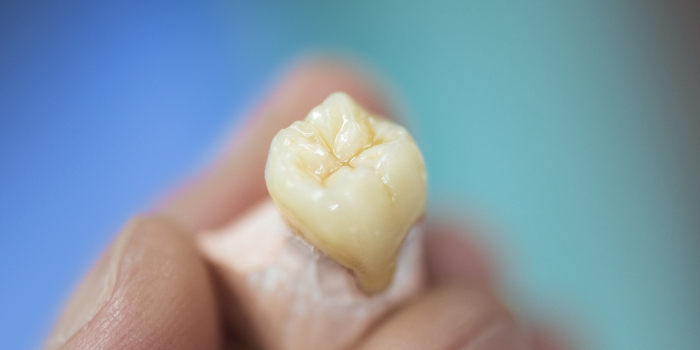 monolithic zirconia crown