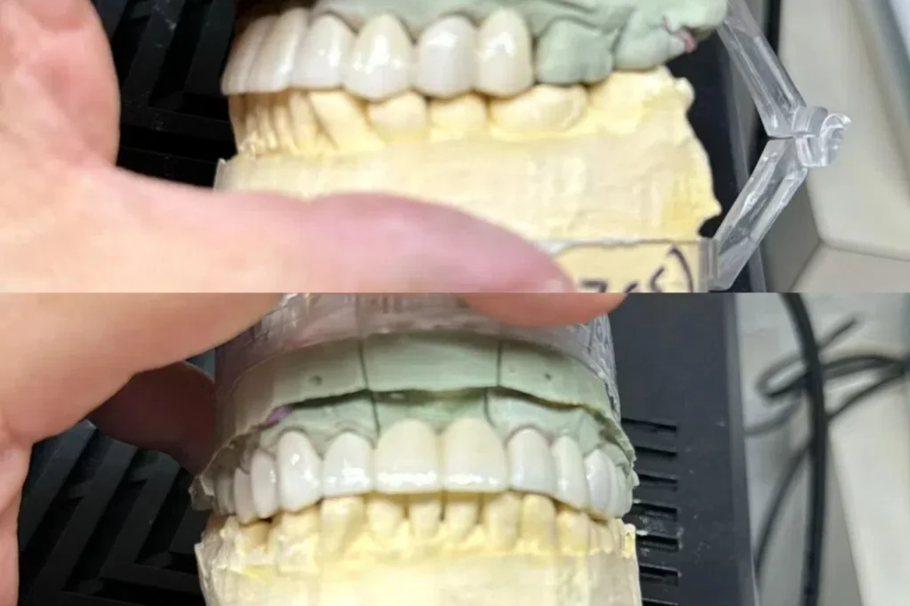 multilayer zirconia crown