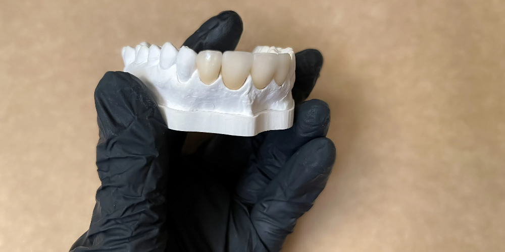 ceramic and zirconia crowns