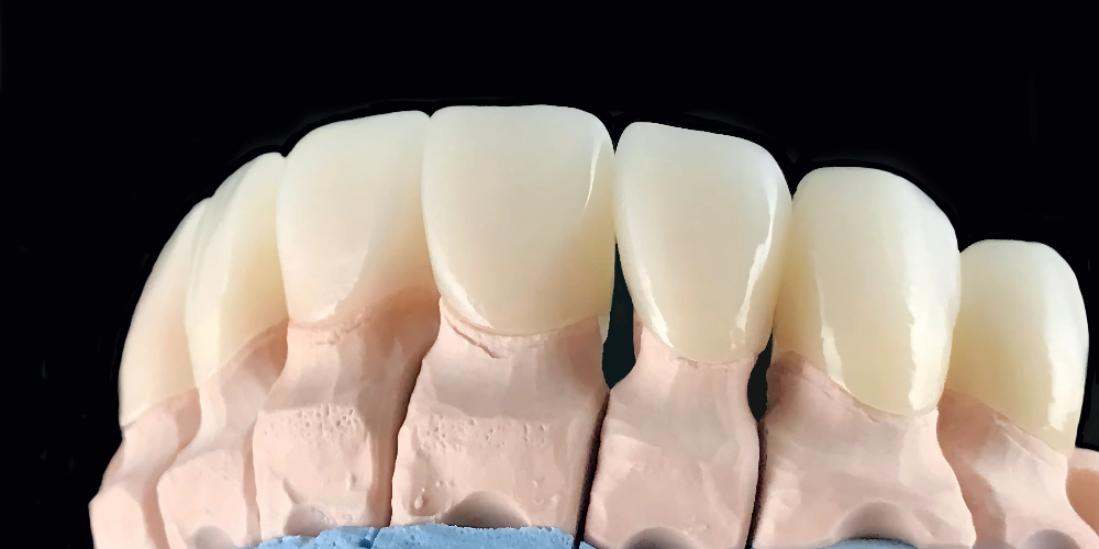 zirconia dental crown