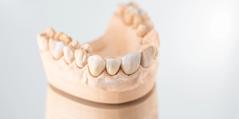 zirconia crown for anterior teeth