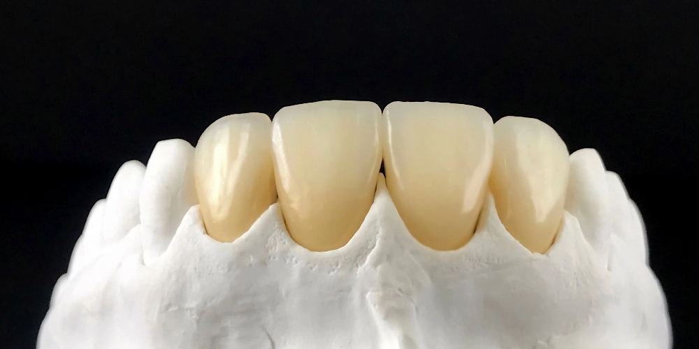 zirconia crown for front teeth