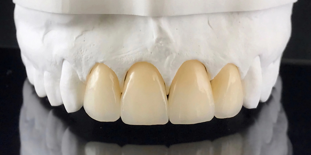 zirconia dental crown