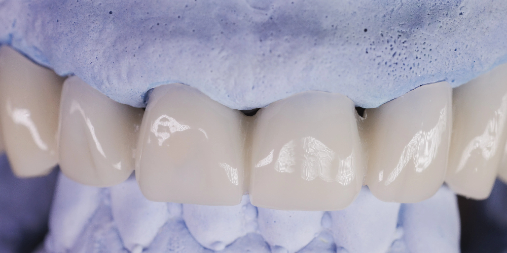 monolithic zirconia bridge