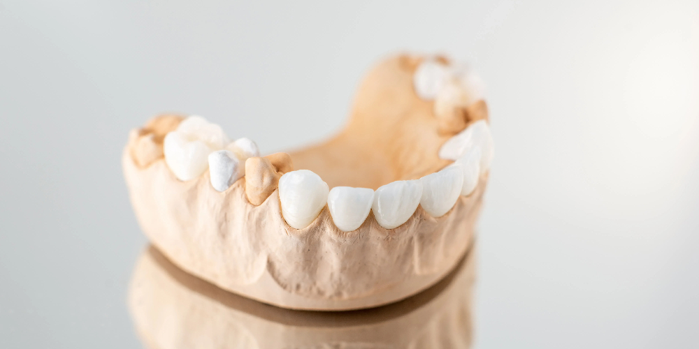 porcelain crown vs zirconia crown