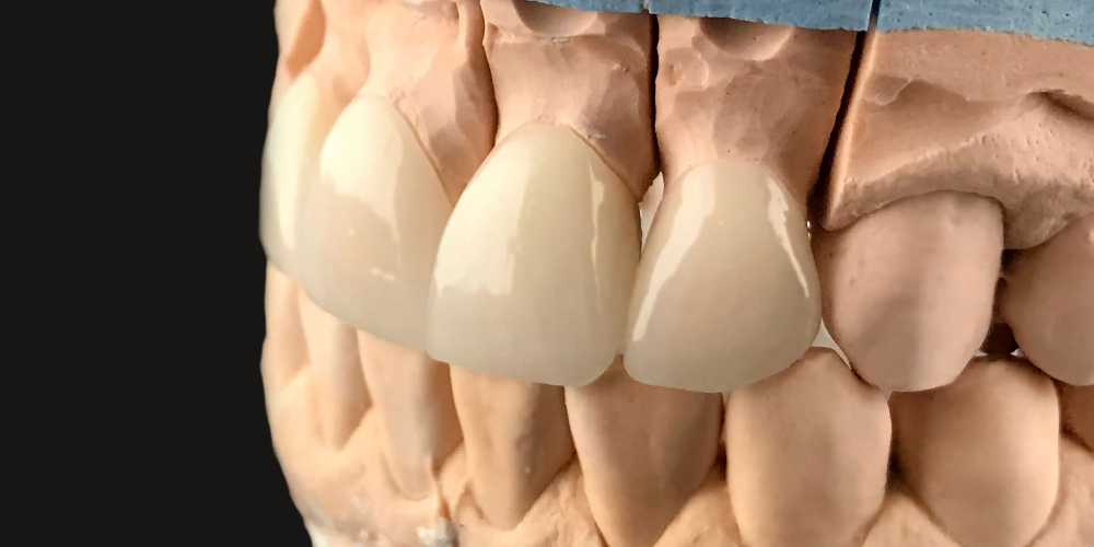 zirconia dental crowns