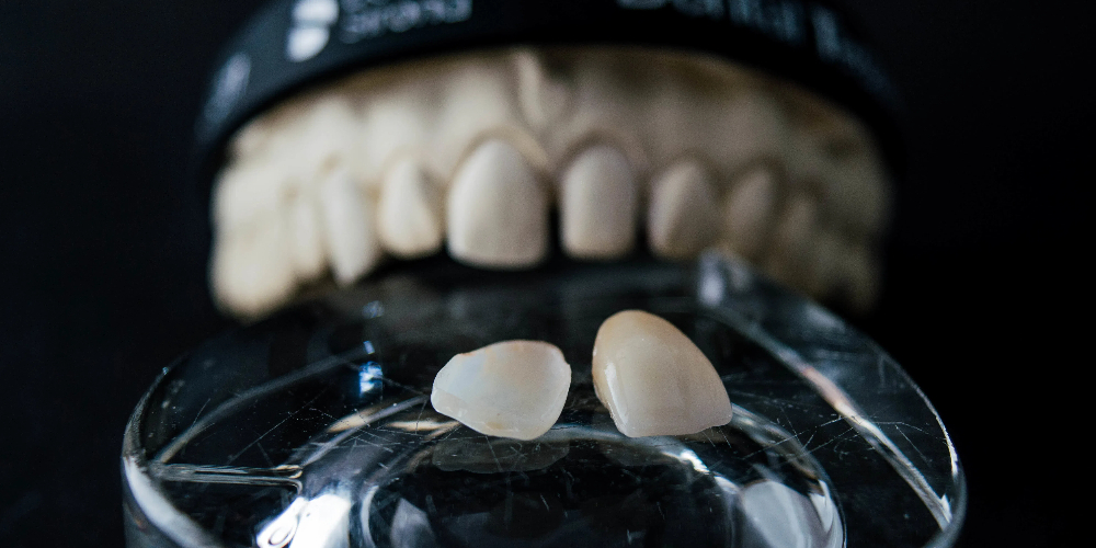 full mouth zirconia crowns