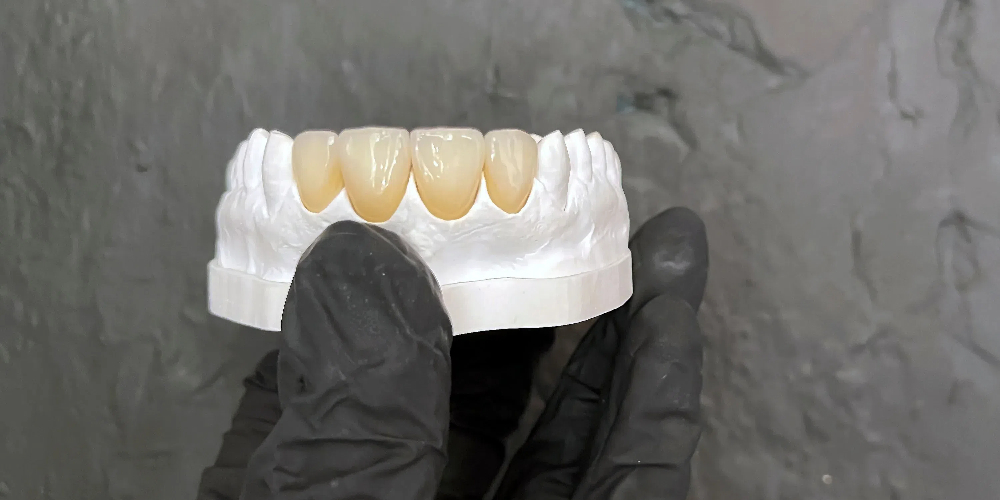 zirconium crowns