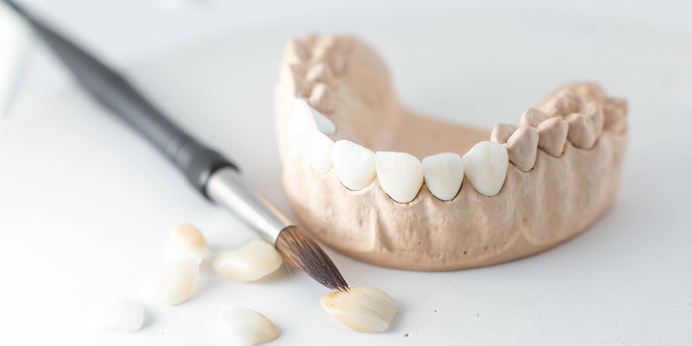 ceramic and zirconia crowns